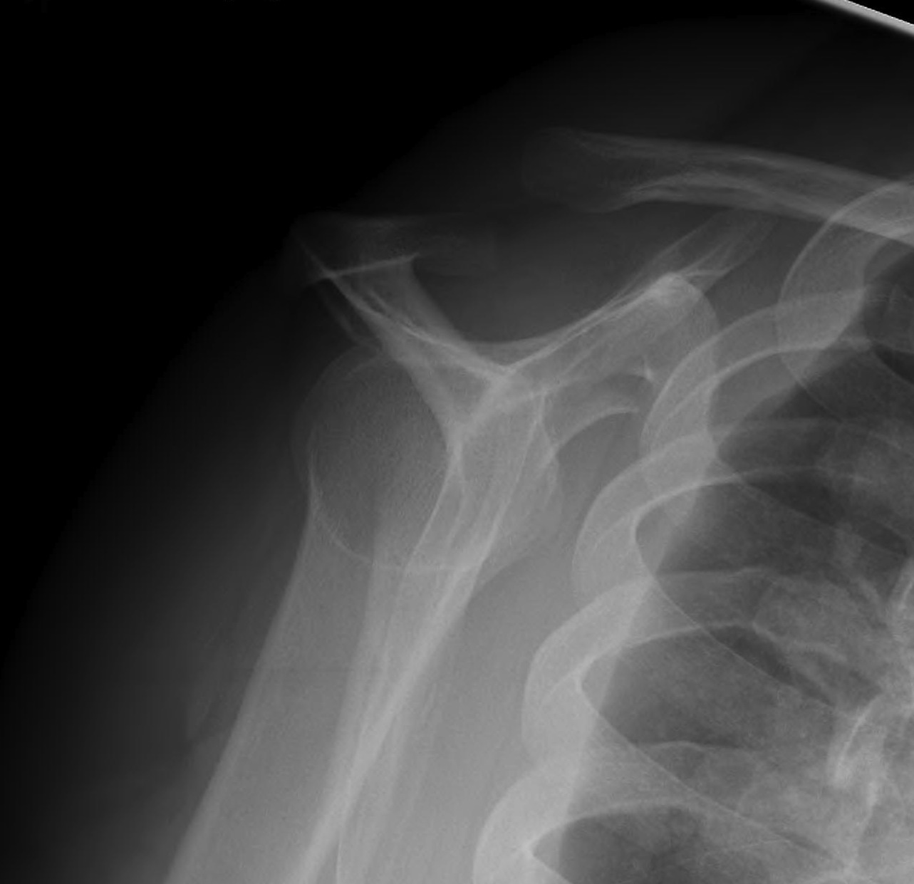 Coracoid Fracture 2